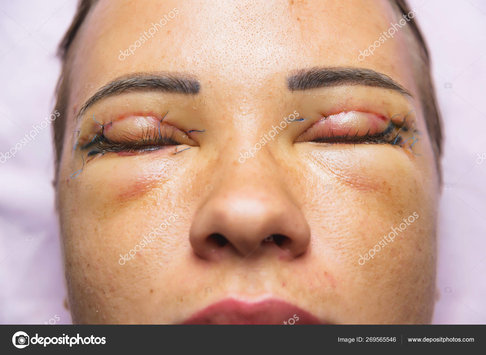 eyelid surgery stitches