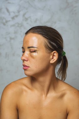 Gözlerinden estetik ameliyat geçirmiş bir kadın. Göz kapaklarında kanama sonrası dikişler var. Göz ve göz fıtığının altındaki torbaların çıkarılmasından hemen sonra yüzünün durumu..