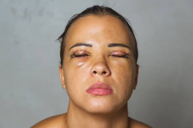 Gözlerinden estetik ameliyat geçirmiş bir kadın. Göz kapaklarında kanama sonrası dikişler var. Göz ve göz fıtığının altındaki torbaların çıkarılmasından hemen sonra yüzünün durumu..