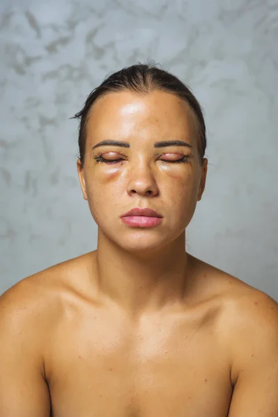 Kvinna Efter Plastikkirurgi Ögonen Sömmar Ögonlocken Efter Blefaroplastik Tillståndet Ansiktet — Stockfoto