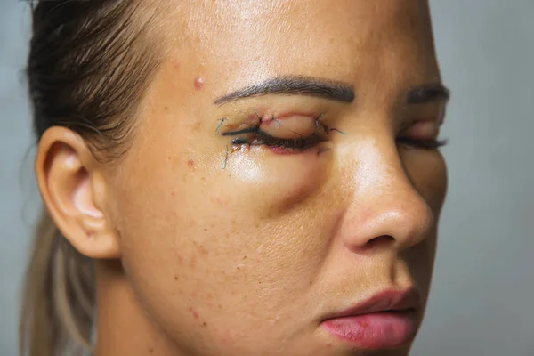 Woman after plastic surgery on the eyes. Stitches on the eyelids after blepharoplasty. The condition of the face immediately after the removal of bags under the eyes and eye hernias.