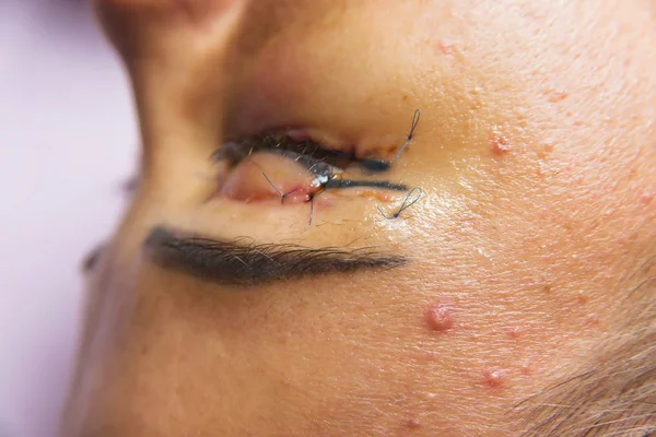 Woman after plastic surgery on the eyes. Stitches on the eyelids after blepharoplasty. The condition of the face immediately after the removal of bags under the eyes and eye hernias.