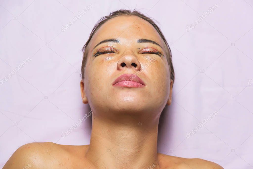 Woman after plastic surgery on the eyes. Stitches on the eyelids after blepharoplasty. The condition of the face immediately after the removal of bags under the eyes and eye hernias.