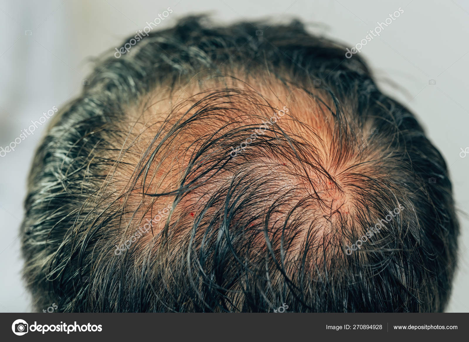 Mesotherapy Hair Head Traces Injections Head Therapy Male Pattern