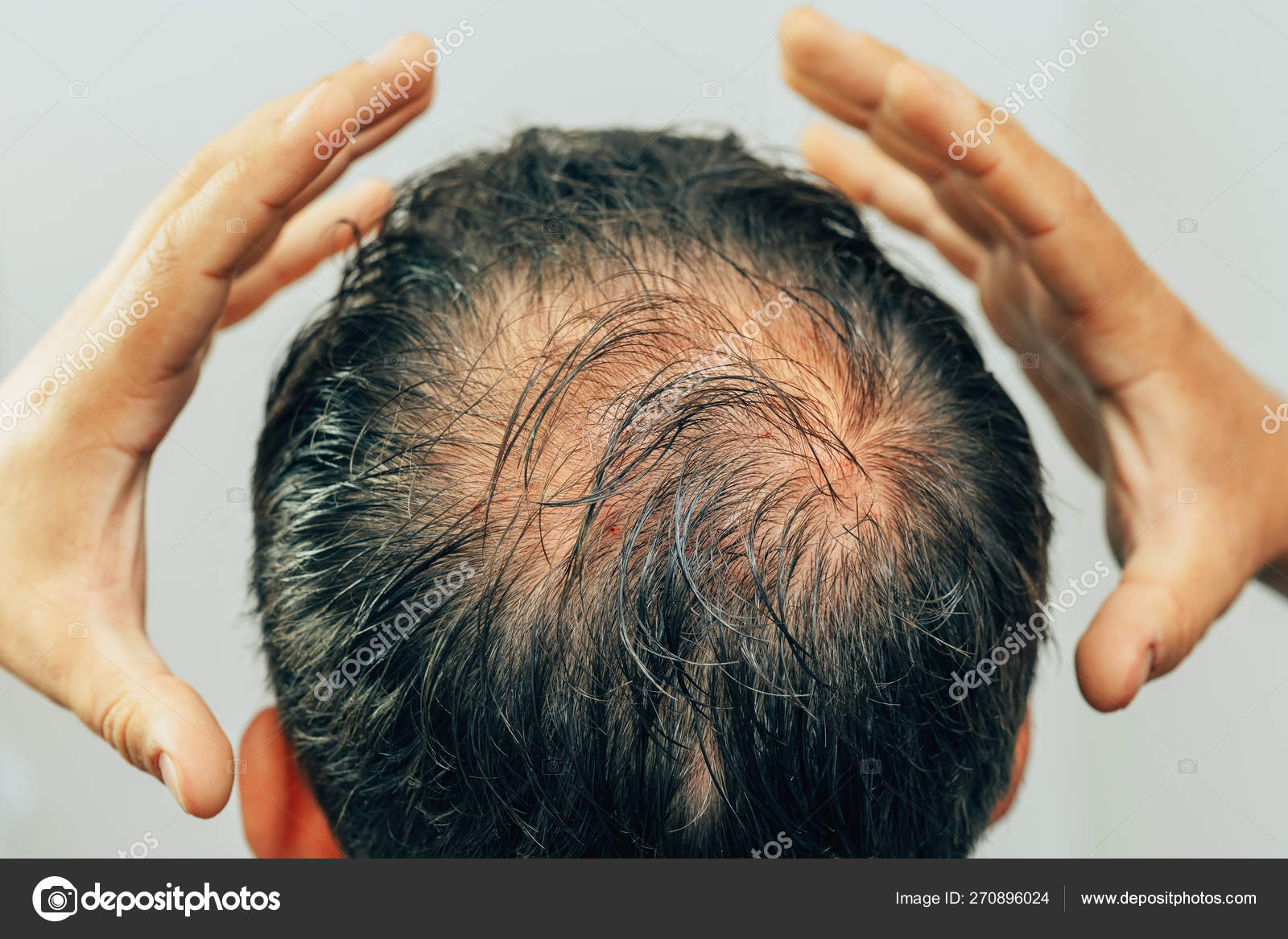 Mesotherapy Hair Head Traces Injections Head Therapy Male Pattern