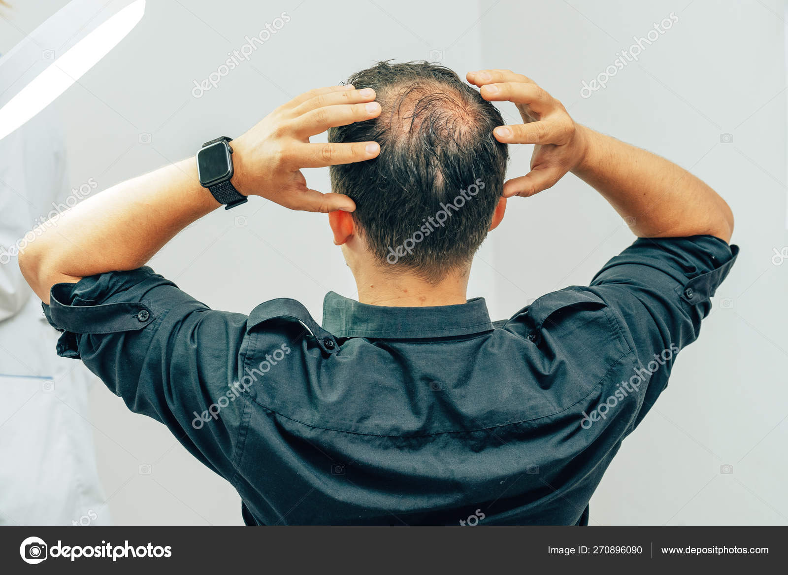 Young Man Bald Spot Office Trichologist Cosmetologist Bald Man