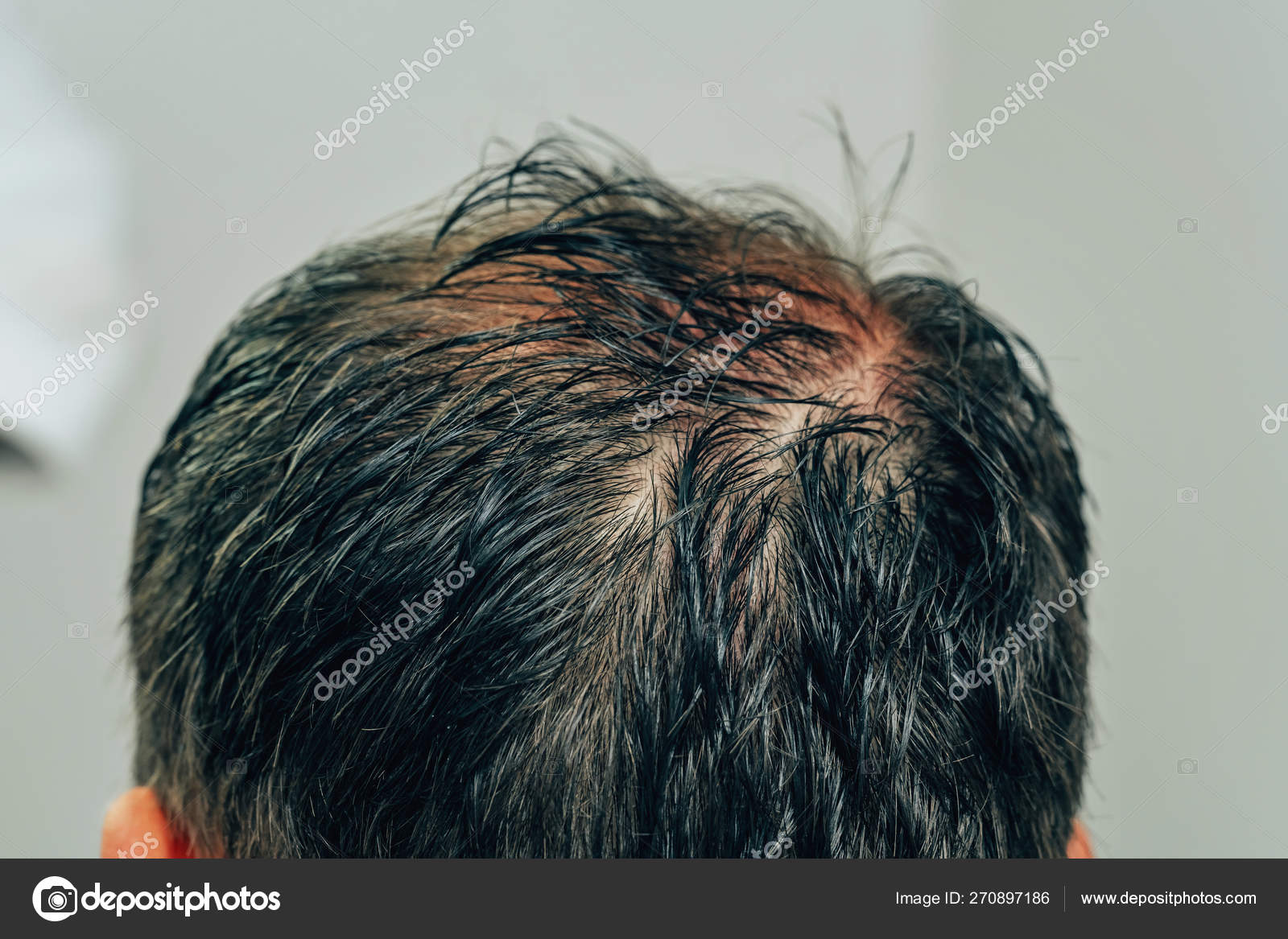 Mesotherapy Hair Head Traces Injections Head Therapy Male Pattern