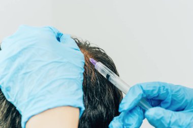 Saç ve baş mezoterapisi. Kafaya iğneler. Erkek tipi kellik. Erkeklerde saç dökülmesiyle mücadele etmek. Taç başında başın ortasında erkek kel nokta. Kozmetolojistin elleri trikolog doktoru ve hastanın başı.