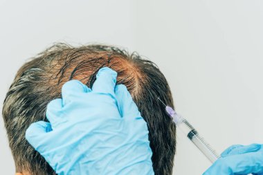 Saç ve baş mezoterapisi. Kafaya iğneler. Erkek tipi kellik. Erkeklerde saç dökülmesiyle mücadele etmek. Taç başında başın ortasında erkek kel nokta. Kozmetolojistin elleri trikolog doktoru ve hastanın başı.