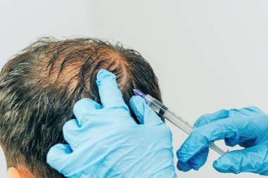 Saç ve baş mezoterapisi. Kafaya iğneler. Erkek tipi kellik. Erkeklerde saç dökülmesiyle mücadele etmek. Taç başında başın ortasında erkek kel nokta. Kozmetolojistin elleri trikolog doktoru ve hastanın başı.