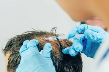 Saç ve baş mezoterapisi. Kafaya iğneler. Erkek tipi kellik. Erkeklerde saç dökülmesiyle mücadele etmek. Taç başında başın ortasında erkek kel nokta. Kozmetolojistin elleri trikolog doktoru ve hastanın başı