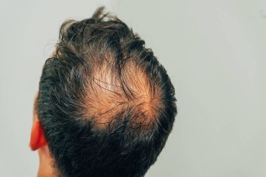 Saç ve baş mezoterapisi. Terapiden sonra kafaya iğne izleri var. Erkek tipi kellik. Erkeklerde saç dökülmesiyle mücadele etmek. Erkeklerin kel kafası en üstte.