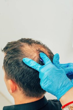 Saç ve baş mezoterapisi. Kafaya iğneler. Erkek tipi kellik. Erkeklerde saç dökülmesiyle mücadele etmek. Taç başında başın ortasında erkek kel nokta. Kozmetolojistin elleri trikolog doktoru ve hastanın başı