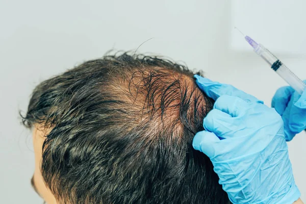 Mesotherapy of hair and head. Injections in the head. Male pattern baldness. Fighting hair loss in men. Men\'s bald spot in the center of the head at the crown. The hands of the cosmetologist the doctor of the trichologist and the head of the patient.