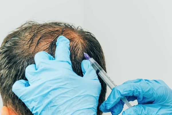 Mesotherapy of hair and head. Injections in the head. Male pattern baldness. Fighting hair loss in men. Men\'s bald spot in the center of the head at the crown. The hands of the cosmetologist the doctor of the trichologist and the head of the patient.