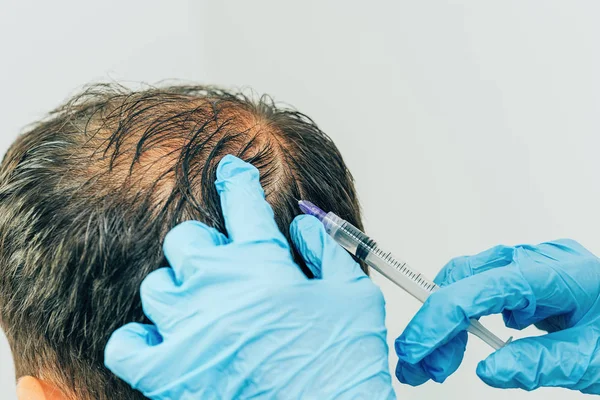 Mesotherapie Van Haar Hoofd Injecties Het Hoofd Mannelijke Kaalheid Vechten — Stockfoto