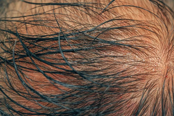Текстура Рідкісного Волосся Голові Чоловіка Мезотерапія Волосся Голови Сліди Уколів — стокове фото