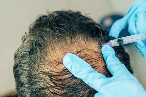 Mesotherapy of hair and head. Injections in the head. Male pattern baldness. Fighting hair loss in men. Men's bald spot in the center of the head at the crown. The hands of the cosmetologist the doctor of the trichologist and the head of the patient