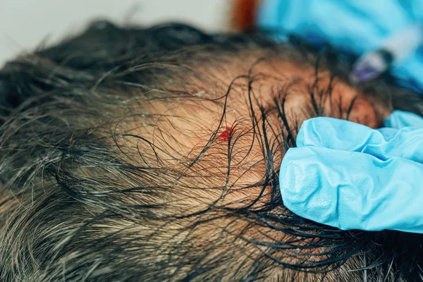 Mezoterapia Włosów Głowy Zastrzyki Głowie Łysiną Walka Wypadania Włosów Mężczyzn — Zdjęcie stockowe