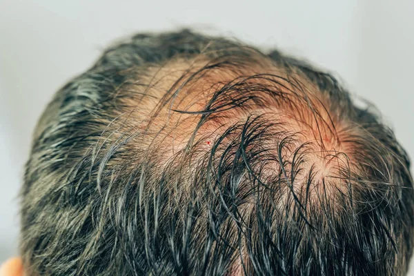 Mesotherapy of hair and head. Traces of injections on the head after therapy. Male pattern baldness. Fighting hair loss in men. Men's bald head at the top.