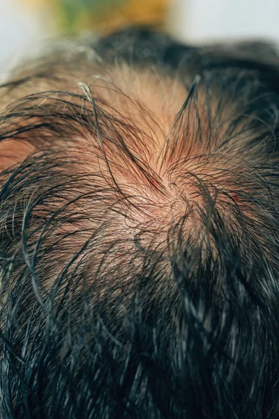 Textura Vzácných Vlasů Hlavě Muže Mezoterapie Vlasů Hlavy Stopy Injekcí — Stock fotografie