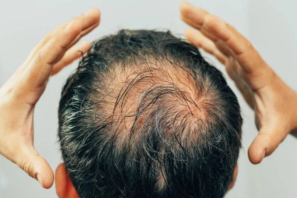 Mesotherapy of hair and head. Traces of injections on the head after therapy. Male pattern baldness. Fighting hair loss in men. Men\'s bald head at the top.