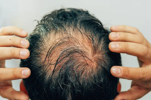 Saç Baş Mezoterapisi Terapiden Sonra Kafaya Iğne Izleri Var Erkek — Stok fotoğraf