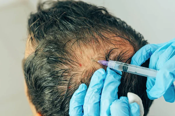 Mesotherapy of hair and head. Injections in the head. Male pattern baldness. Fighting hair loss in men. Men\'s bald spot in the center of the head at the crown. The hands of the cosmetologist the doctor of the trichologist and the head of the patient