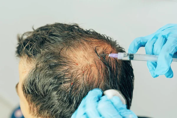 Mesotherapy of hair and head. Injections in the head. Male pattern baldness. Fighting hair loss in men. Men\'s bald spot in the center of the head at the crown. The hands of the cosmetologist the doctor of the trichologist and the head of the patient