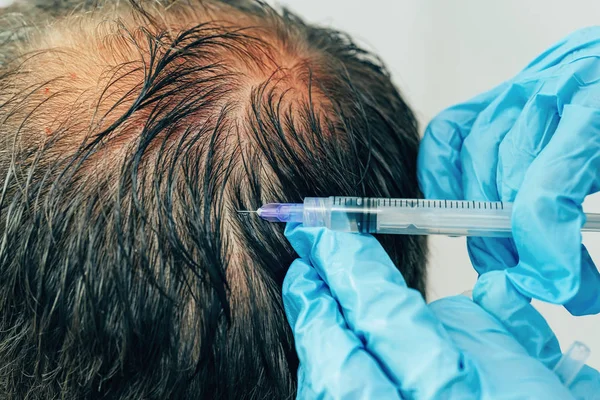 Mesotherapy of hair and head. Injections in the head. Male pattern baldness. Fighting hair loss in men. Men\'s bald spot in the center of the head at the crown. The hands of the cosmetologist the doctor of the trichologist and the head of the patient
