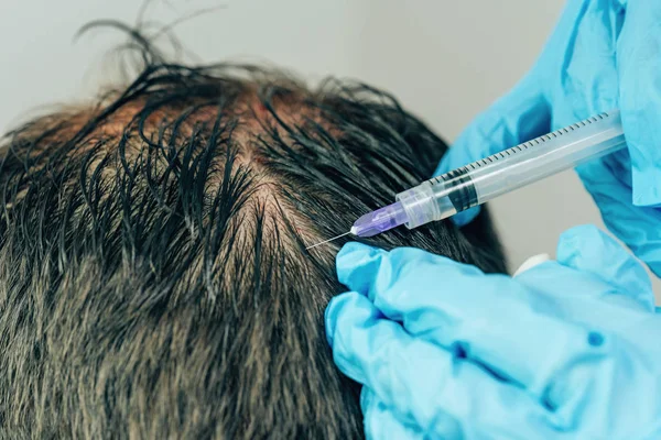 Mesotherapy of hair and head. Injections in the head. Male pattern baldness. Fighting hair loss in men. Men\'s bald spot in the center of the head at the crown. The hands of the cosmetologist the doctor of the trichologist and the head of the patient