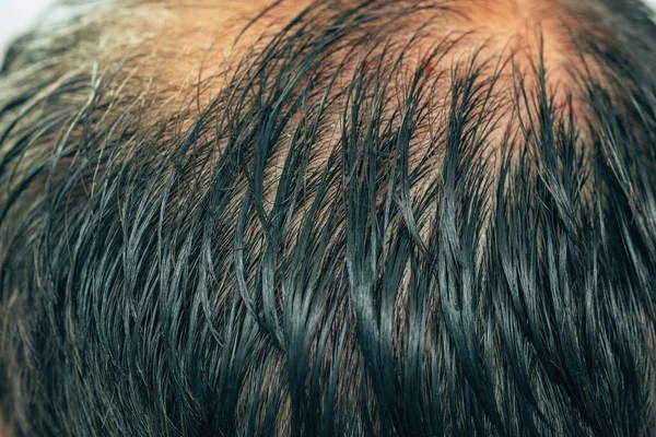 Textura Vzácných Vlasů Hlavě Muže Mezoterapie Vlasů Hlavy Stopy Injekcí — Stock fotografie