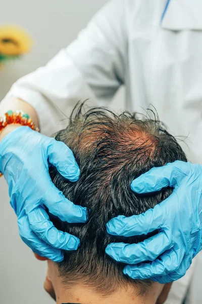 Preparing for mesotherapy of hair and head. Fighting hair loss in men. Injections in the head. Treatment methods for male pattern baldness. Early hair loss