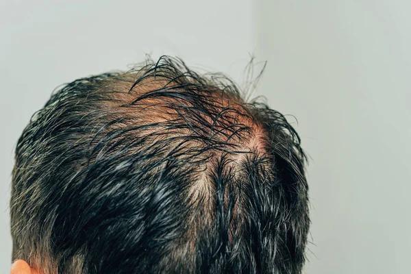 Μεσοθεραπεία Μαλλιών Και Κεφαλιού Ίχνη Από Ενέσεις Στο Κεφάλι Μετά — Φωτογραφία Αρχείου