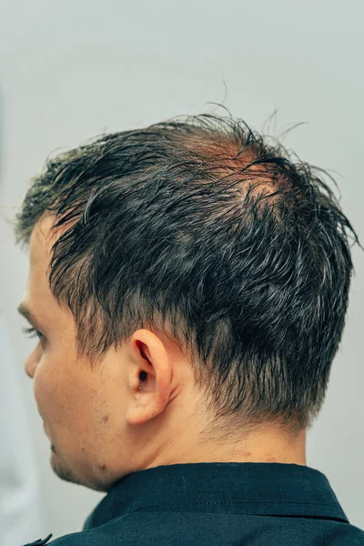 Preparing for mesotherapy of hair and head. Fighting hair loss in men. Injections in the head. Treatment methods for male pattern baldness. Early hair loss