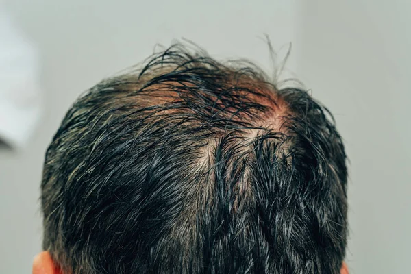 Mesotherapy of hair and head. Traces of injections on the head after therapy. Male pattern baldness. Fighting hair loss in men. Men\'s bald head at the top.