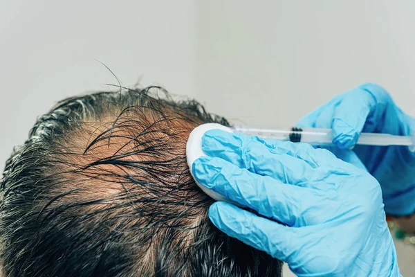 Mesotherapy of hair and head. Injections in the head. Male pattern baldness. Fighting hair loss in men. Men's bald spot in the center of the head at the crown. The hands of the cosmetologist the doctor of the trichologist and the head of the patient