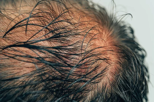 The texture of the rare hair on the head of a man. Mesotherapy of hair and head. Traces of injections on the head after therapy. Male pattern baldness. Fighting hair loss in men.