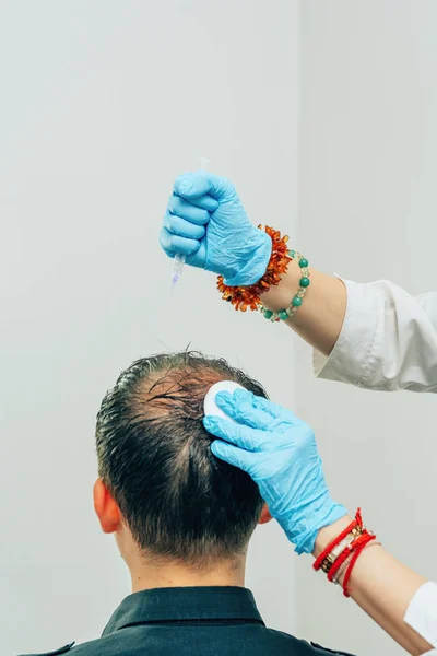 Mesotherapy of hair and head. Injections in the head. Male pattern baldness. Fighting hair loss in men. Men\'s bald spot in the center of the head at the crown. The hands of the cosmetologist the doctor of the trichologist and the head of the patient