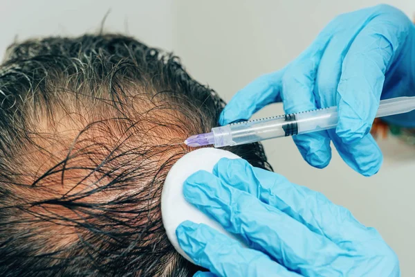 Mesotherapy of hair and head. Injections in the head. Male pattern baldness. Fighting hair loss in men. Men\'s bald spot in the center of the head at the crown. The hands of the cosmetologist the doctor of the trichologist and the head of the patient