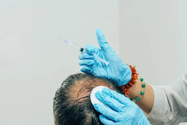 Mesotherapy of hair and head. Injections in the head. Male pattern baldness. Fighting hair loss in men. Men's bald spot in the center of the head at the crown. The hands of the cosmetologist the doctor of the trichologist and the head of the patient