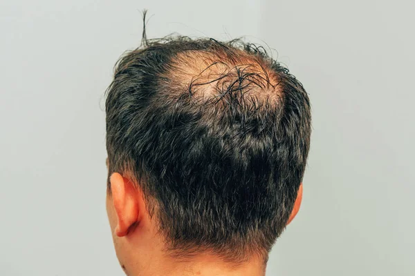 Mezoterapie Vlasů Hlavy Stopy Injekcí Hlavě Terapii Mužská Plešatost Bojovat — Stock fotografie