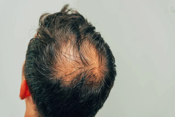 Mesotherapy of hair and head. Traces of injections on the head after therapy. Male pattern baldness. Fighting hair loss in men. Men\'s bald head at the top.