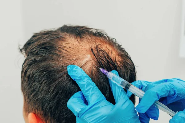 Mesotherapy of hair and head. Injections in the head. Male pattern baldness. Fighting hair loss in men. Men\'s bald spot in the center of the head at the crown. The hands of the cosmetologist the doctor of the trichologist and the head of the patient