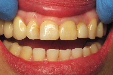 İnsanlarda sağlıklı dişler. Diş kliniğinde plak çıkarılması. Diş hekiminde diş çürüklerinin tedavisi. Diş implantları kuruyor. Hastada seramik protezler