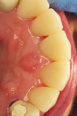İnsanlarda sağlıklı dişler. Diş kliniğinde plak çıkarılması. Diş hekiminde diş çürüklerinin tedavisi. Diş implantları kuruyor. Hastada seramik protezler