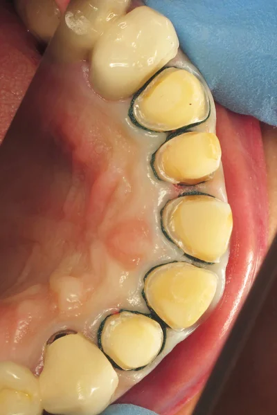 歯の古い詰め物を取り除きます 歯科医院での悪い歯の治療 前歯の修復 セラミック歯科インプラントのインストール カスタマイズされた入れ歯を作る — ストック写真