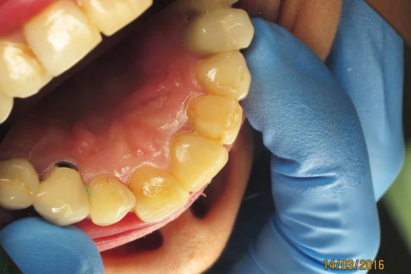 人間の健康な歯歯科医院のプラークの除去 歯科医での齲蝕の治療 歯科インプラントの取付け 患者のセラミック入れ歯 — ストック写真