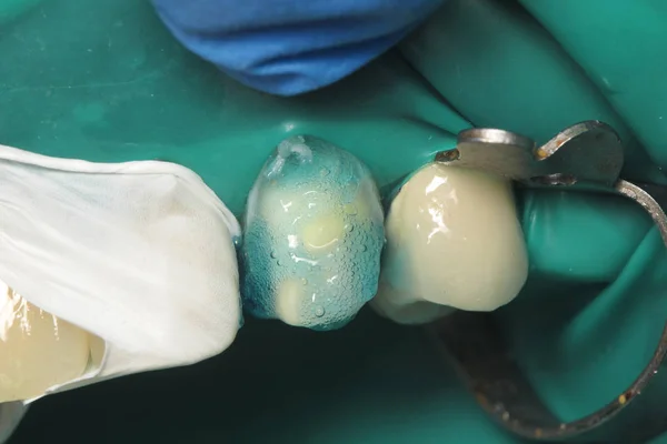 拆下牙齿中的旧填充物 牙科诊所的坏牙治疗 前牙的修复 安装陶瓷牙种植体 制作定制假牙 — 图库照片