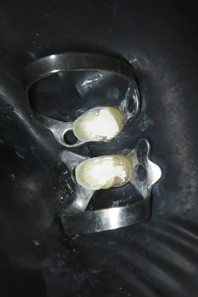 Удалите Старые Пломбы Зубе Лечение Зубов Стоматологической Клинике Восстановление Зубов — стоковое фото